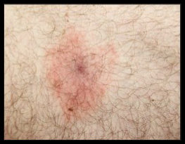 tick bite lyme disease